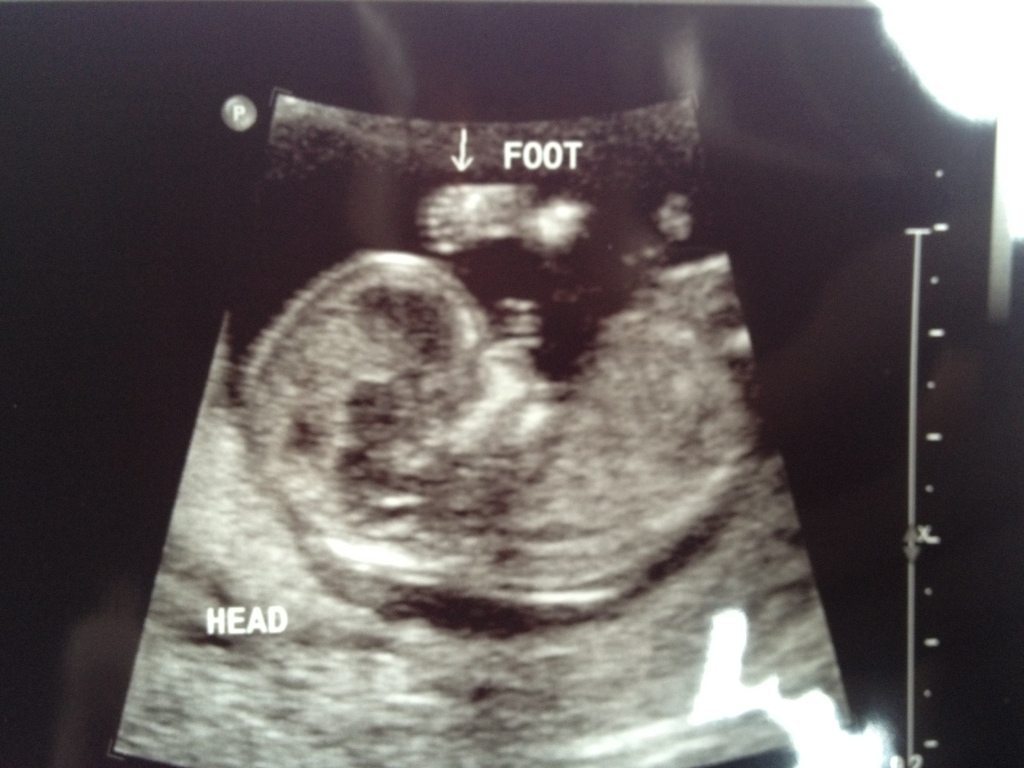Ultrasound 12 Wks Foot